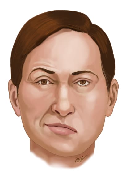 FacialPalsy